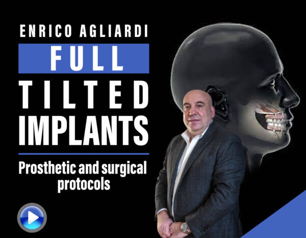 Full tilted implants Prosthetic and Surgical protocols 2023 (Osteocom)