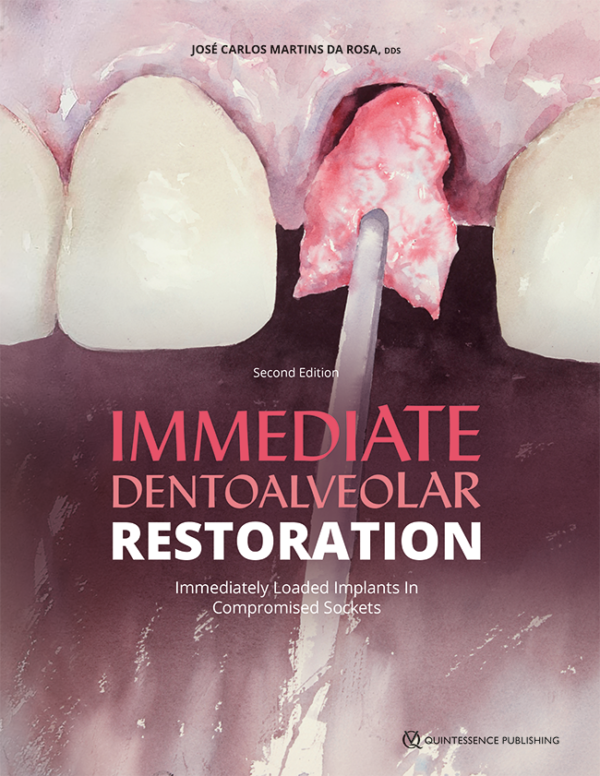 IDR Immediate Dentoalveolar Restoration Immediately Loaded Implants in Compromised Sockets